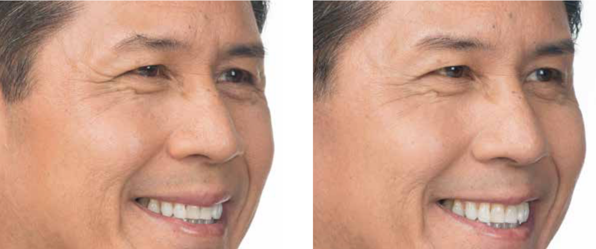 real patient before and after treatment with Botox injection