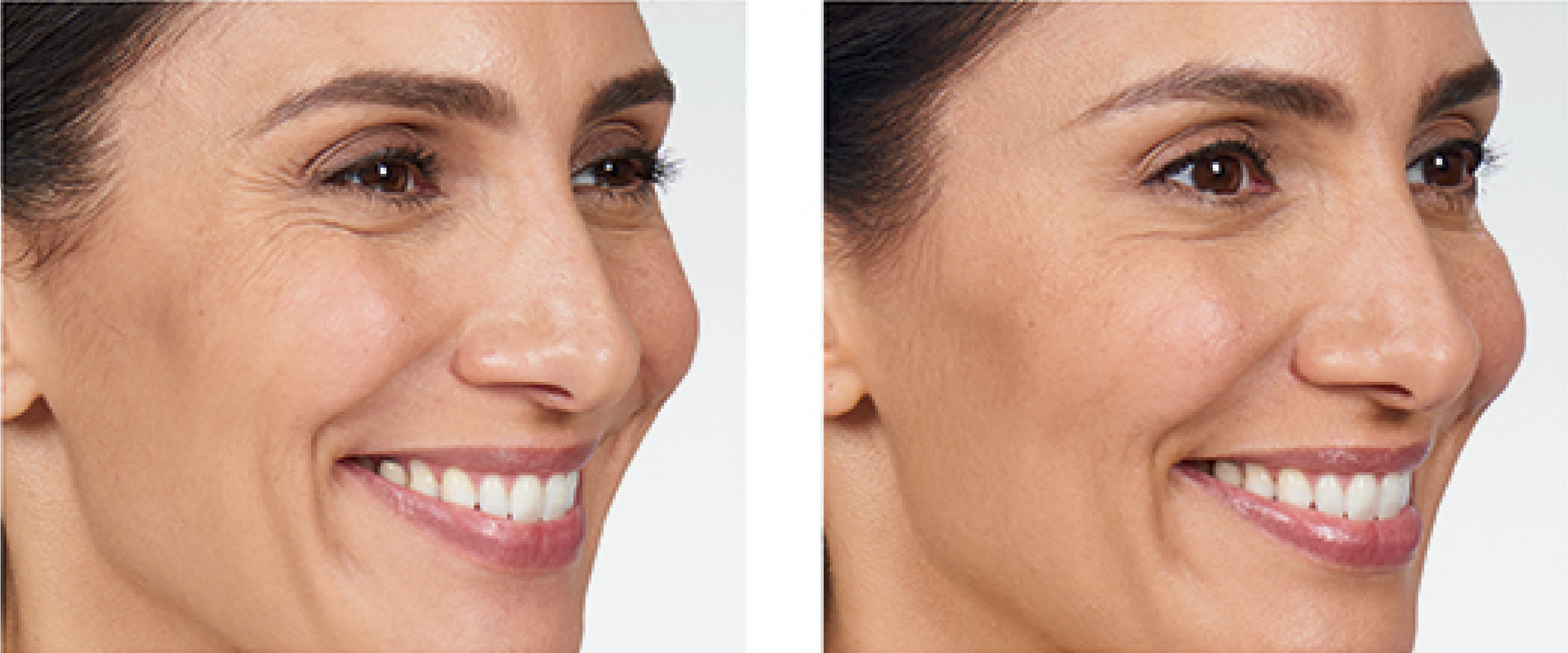 real patient before and after treatment with Botox injection