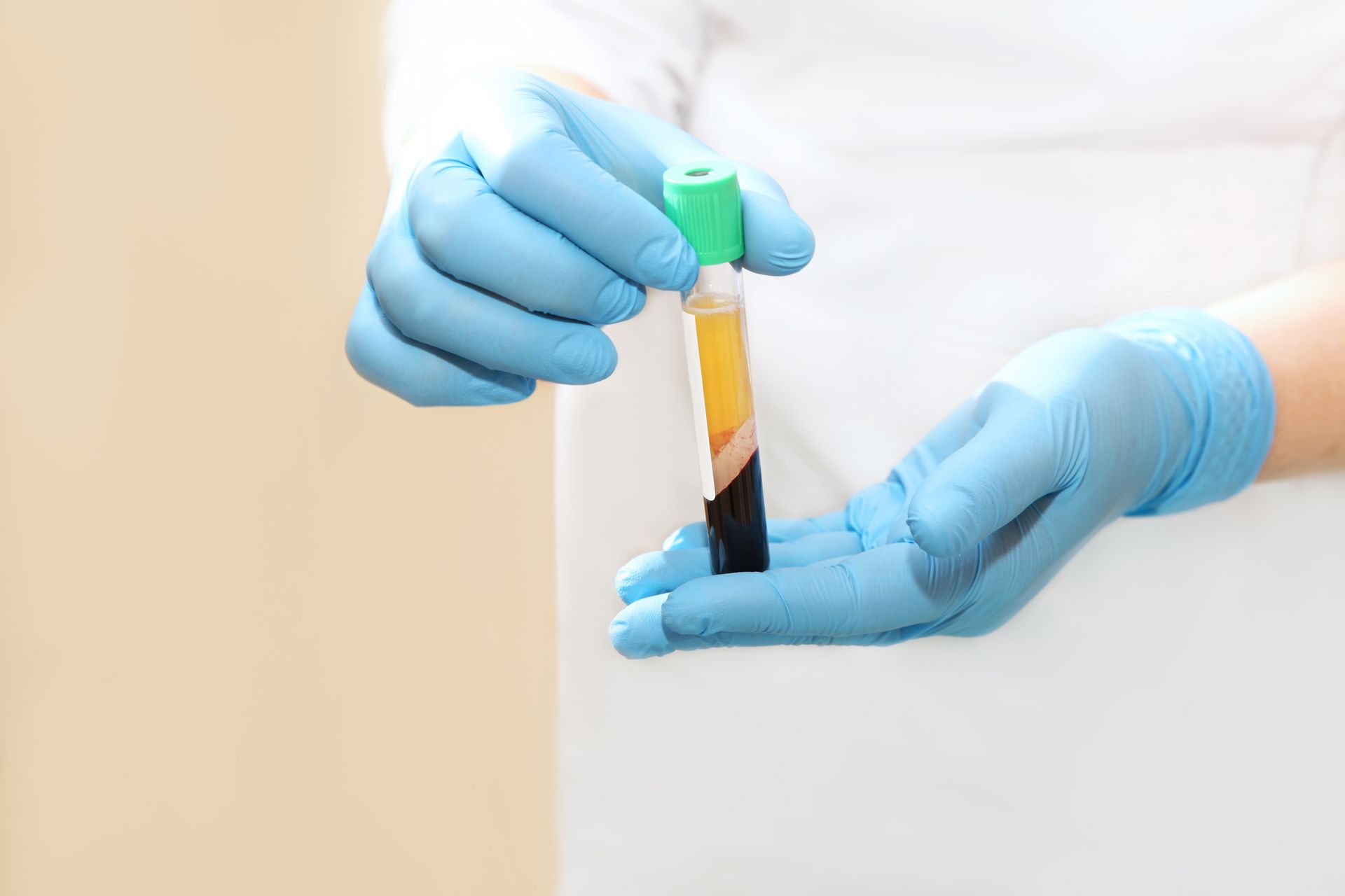 closeup of doctor holding tube of blood and blood plasma after drawn from patient