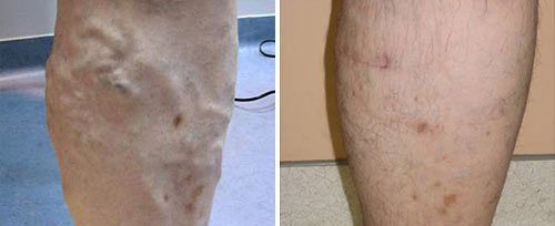 A before and after photo of a person 's leg with varicose veins.