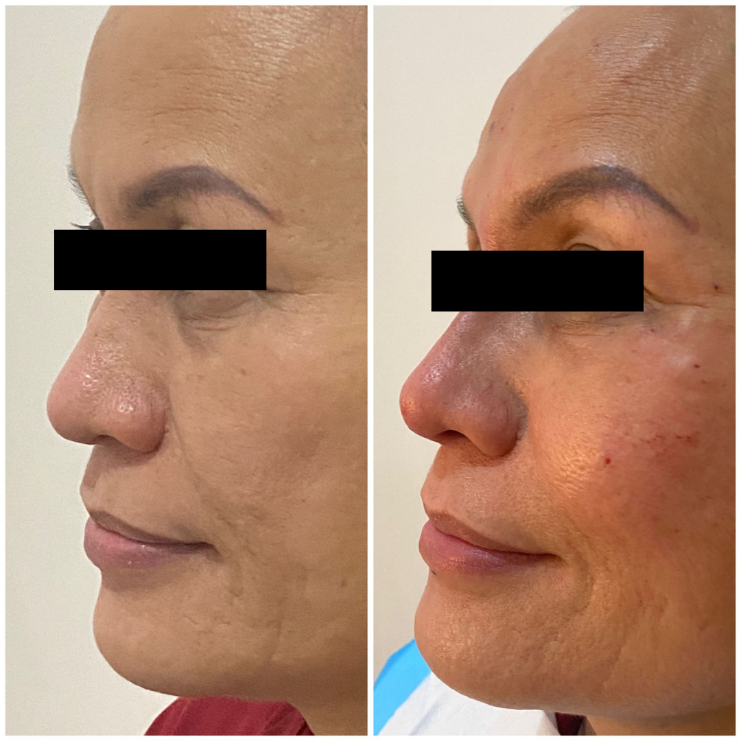 PATIENT PHOTO HIKO NOSE FILLER AND THREAD