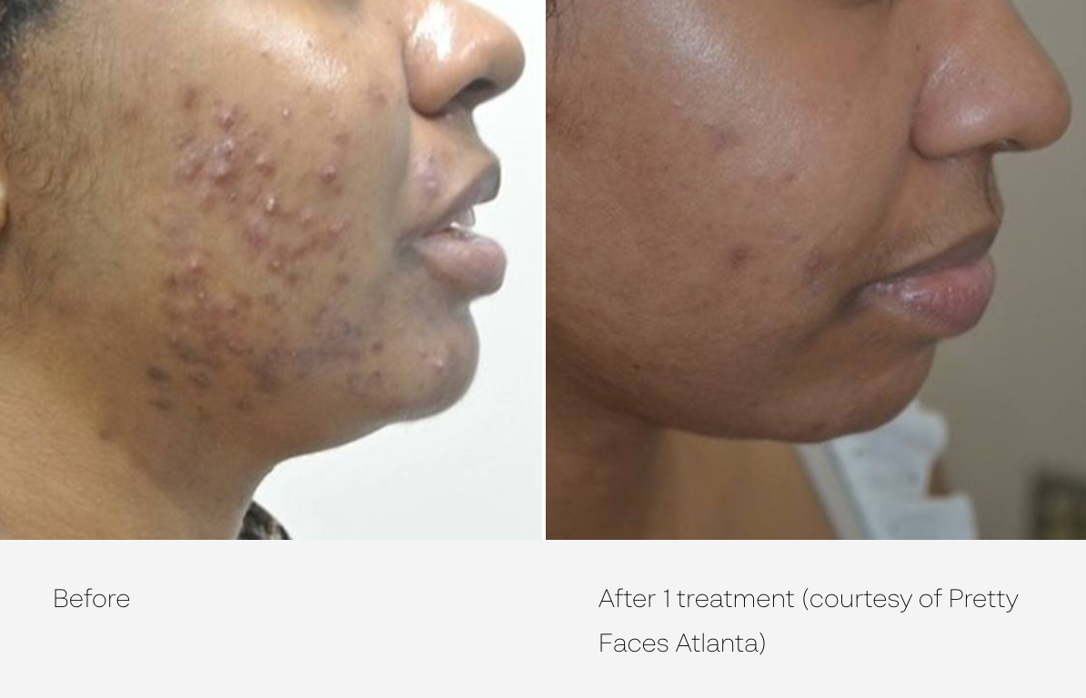 before and after picosure pro