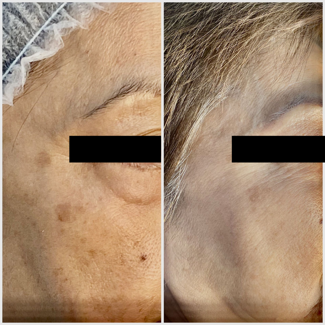 PATIENT PHOTO PIGMENT REMOVAL BY PICOSURE PRO