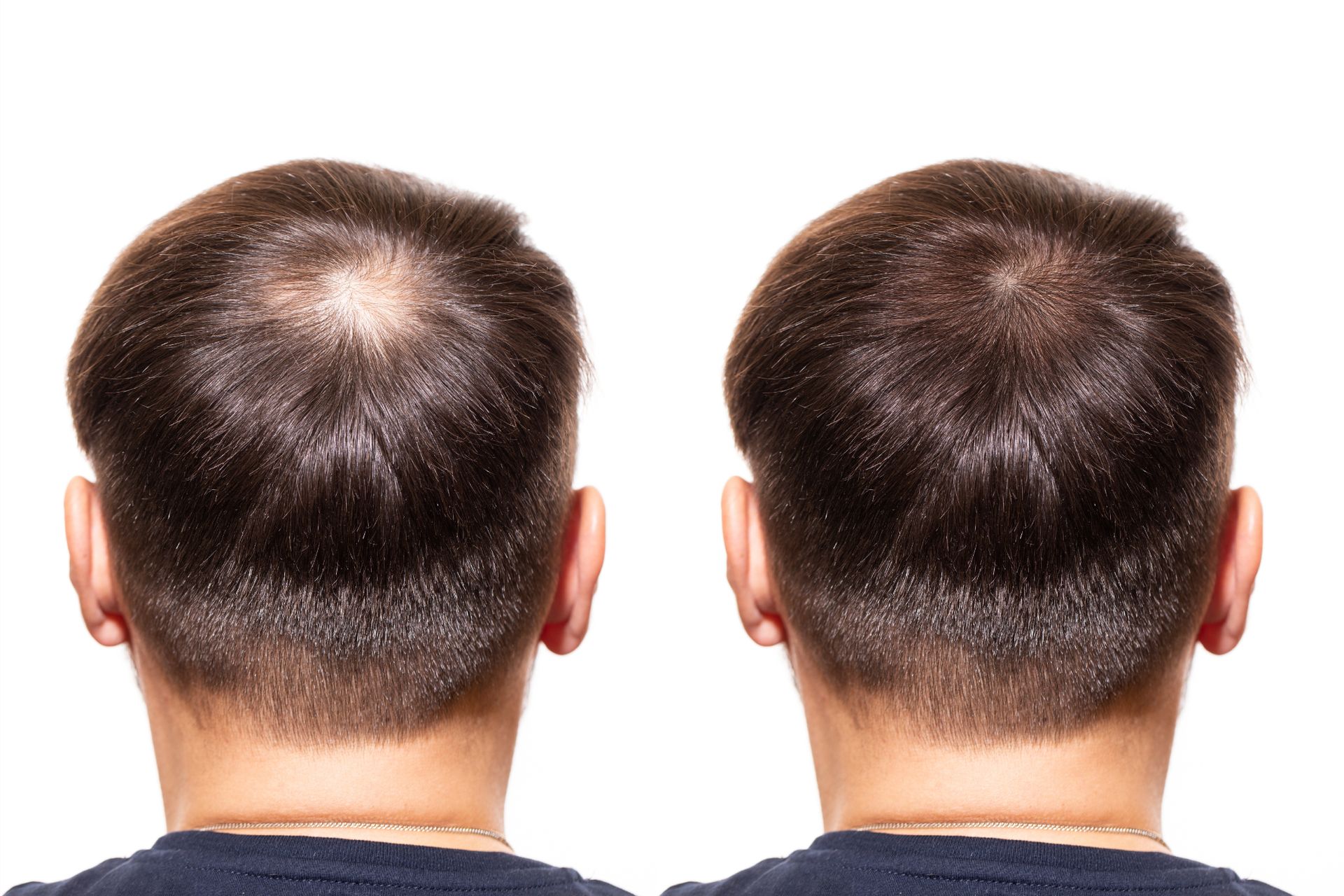 rear view of a man's head, showing bald spot before and after treatment for hair loss