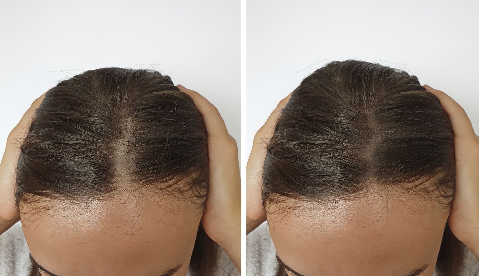 closeup of woman showing parted hair before and after hair loss treatment