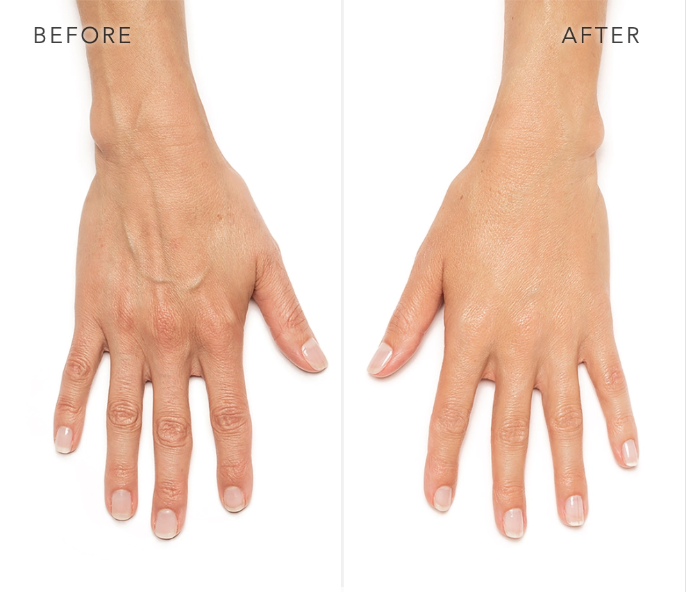 real patient shown before and after treatment with Radiesse