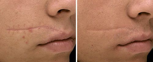 A before and after photo of a woman 's face with a scar.