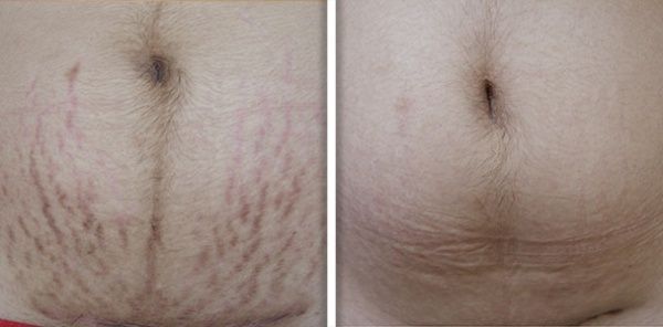 patient before and after treatment with Fotona laser