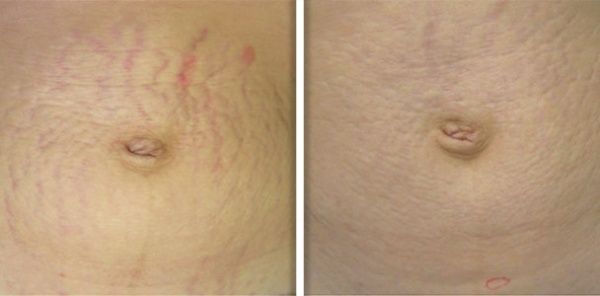 patient before and after treatment with Fotona laser