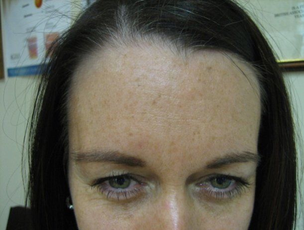 Anti-wrinkle injections - Manchester - Queens Park Clinic - Frown Lines