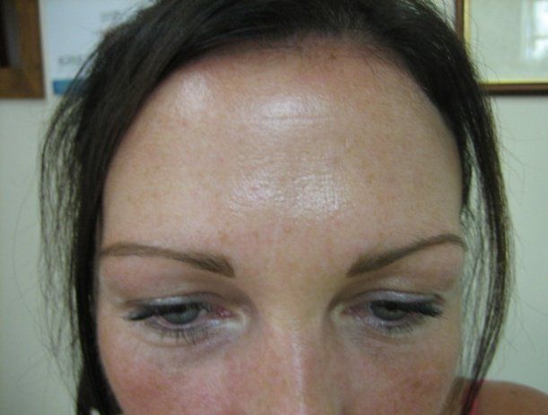 Anti-wrinkle injections - Manchester - Queens Park Clinic - Frown Lines