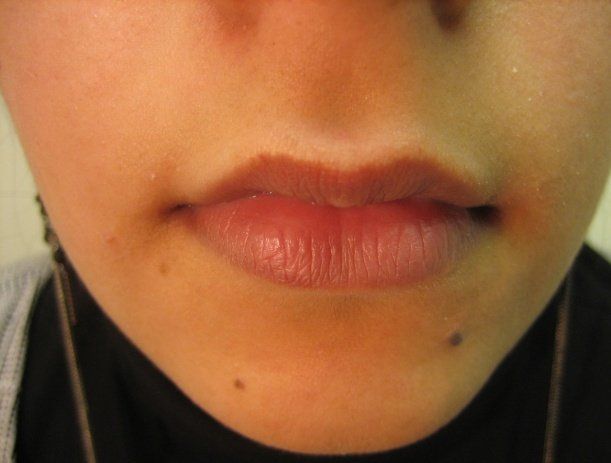 Medical skin treatments - Manchester - Queens Park Clinic - Lip Enhancement