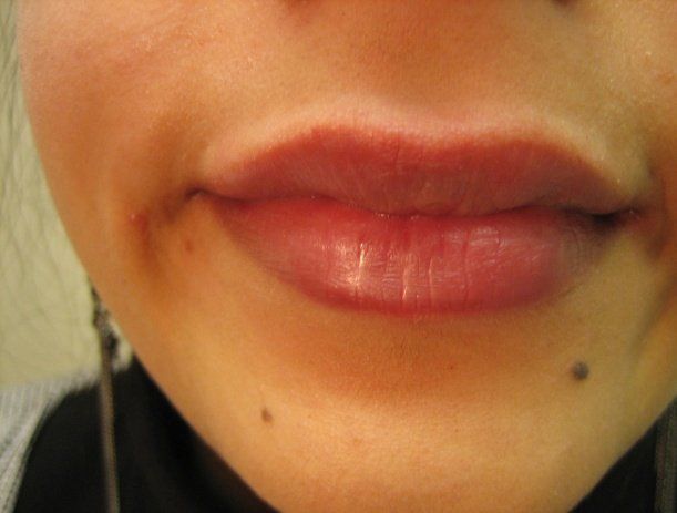 Loose skin - Manchester - Queens Park Clinic - Lip Enhancement