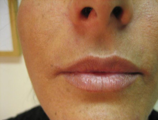 Lip enhancement - Manchester - Queens Park Clinic - Lip Enhancement