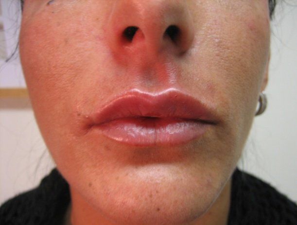 Acne treatments - Manchester - Queens Park Clinic - Lip Enhancement