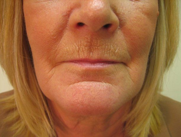 Anti-wrinkle treatment - Manchester - Queens Park Clinic - Other Areas