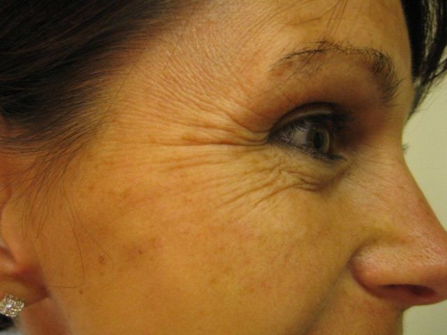 Beauty treatments - Manchester - Queens Park Clinic - Crows Feet