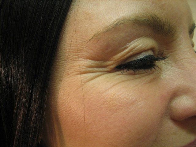 Skin blemish treatments - Manchester - Queens Park Clinic - Crows Feet