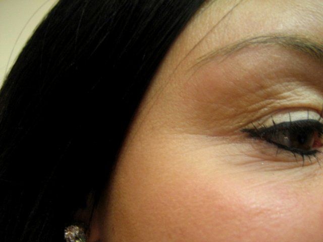 Cosmetic treatments - Manchester - Queens Park Clinic - Crows Feet