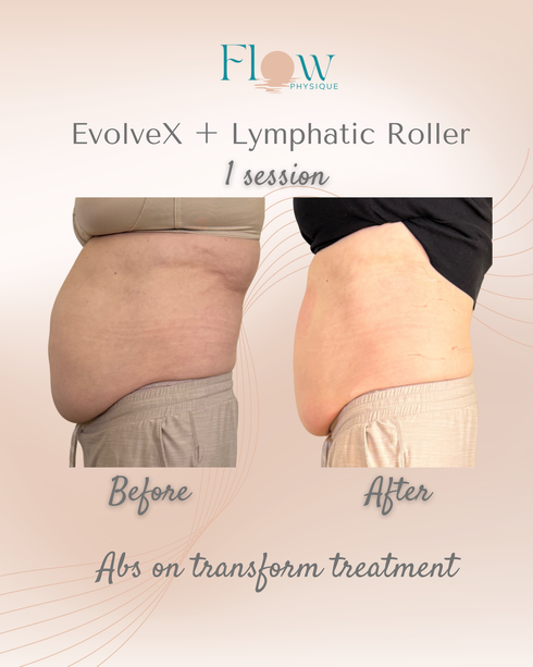 After one Evolve-X session with lymphatic body roller at Flow Physique Chermside showing visible abdominal toning
