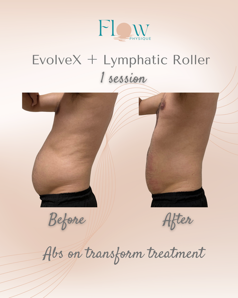 Side profile results after one Evolve-X session and lymphatic roller treatment at Flow Physique Chermside