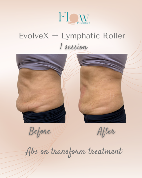 Lower abdomen toning after one Evolve-X session with lymphatic body roller at Flow Physique Chermside