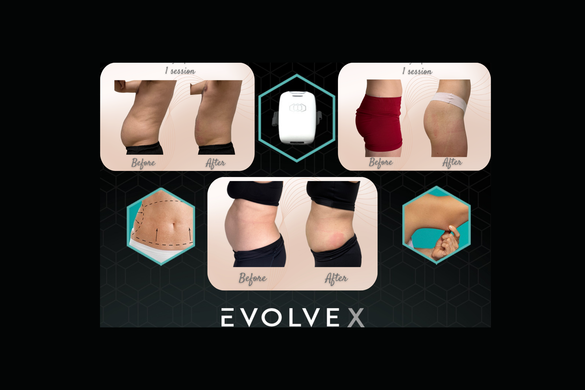 Stubborn fat muscle tone results from Evolve-X EMS and RF treatments