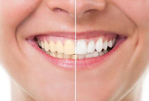 Before and after whitening — Dental Service in North Tonawanda, NY