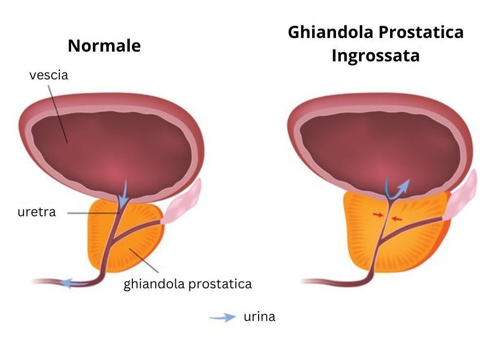 Iperplasia prostatica benigna