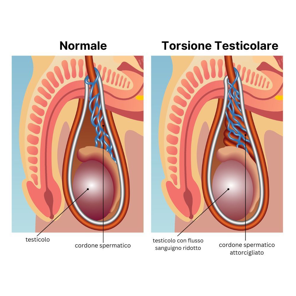 Torsione Testicolare