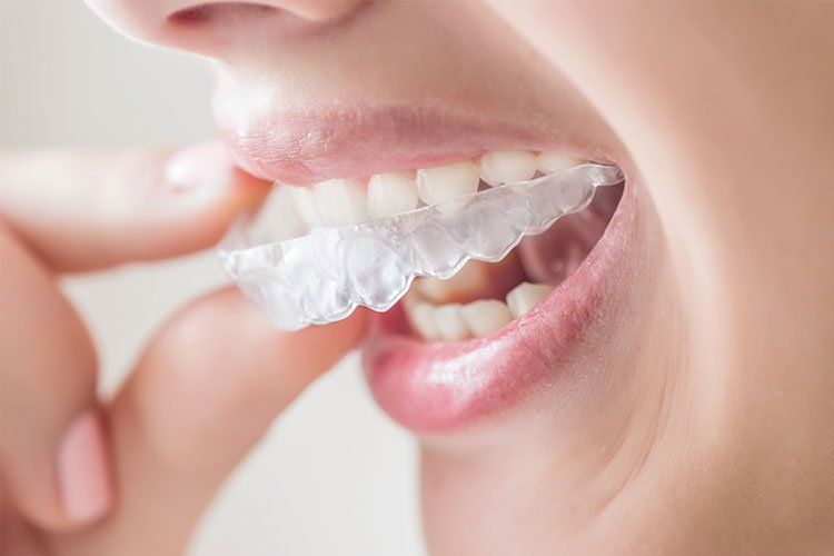 a woman is wearing a clear retainer on her teeth .