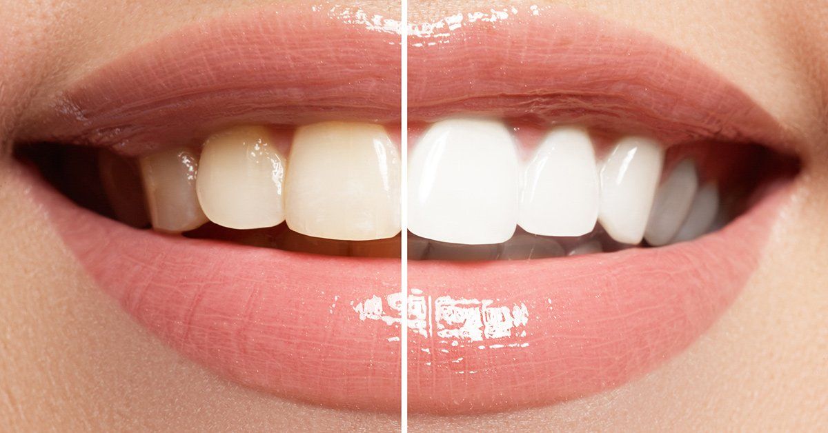 a woman 's teeth before and after whitening .