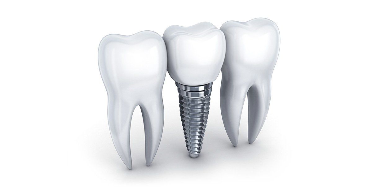 cost of dental implants, dentist in Brewster NY