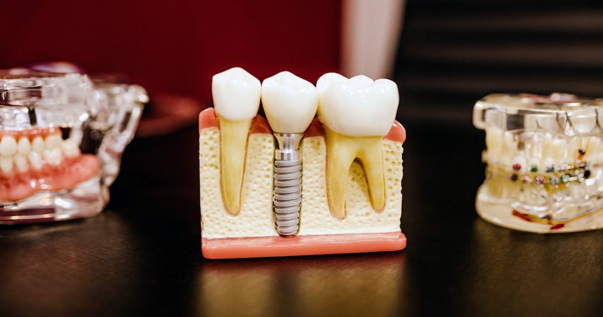 a model of a dental implant is sitting on a table next to other models of teeth .
