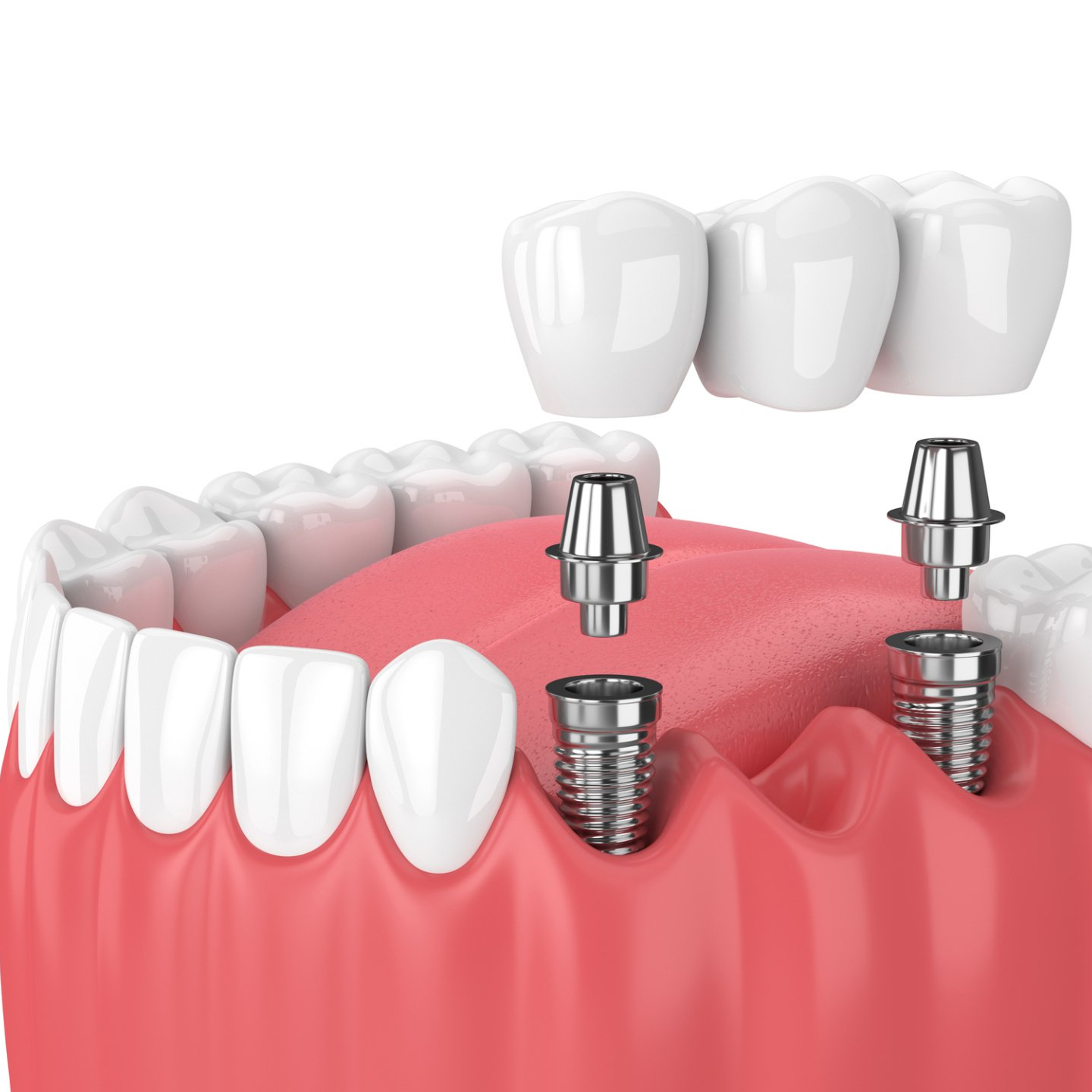 Tooth Replacement — Cary & Garner, NC — Cusumano Oral Surgery & Implant Center
