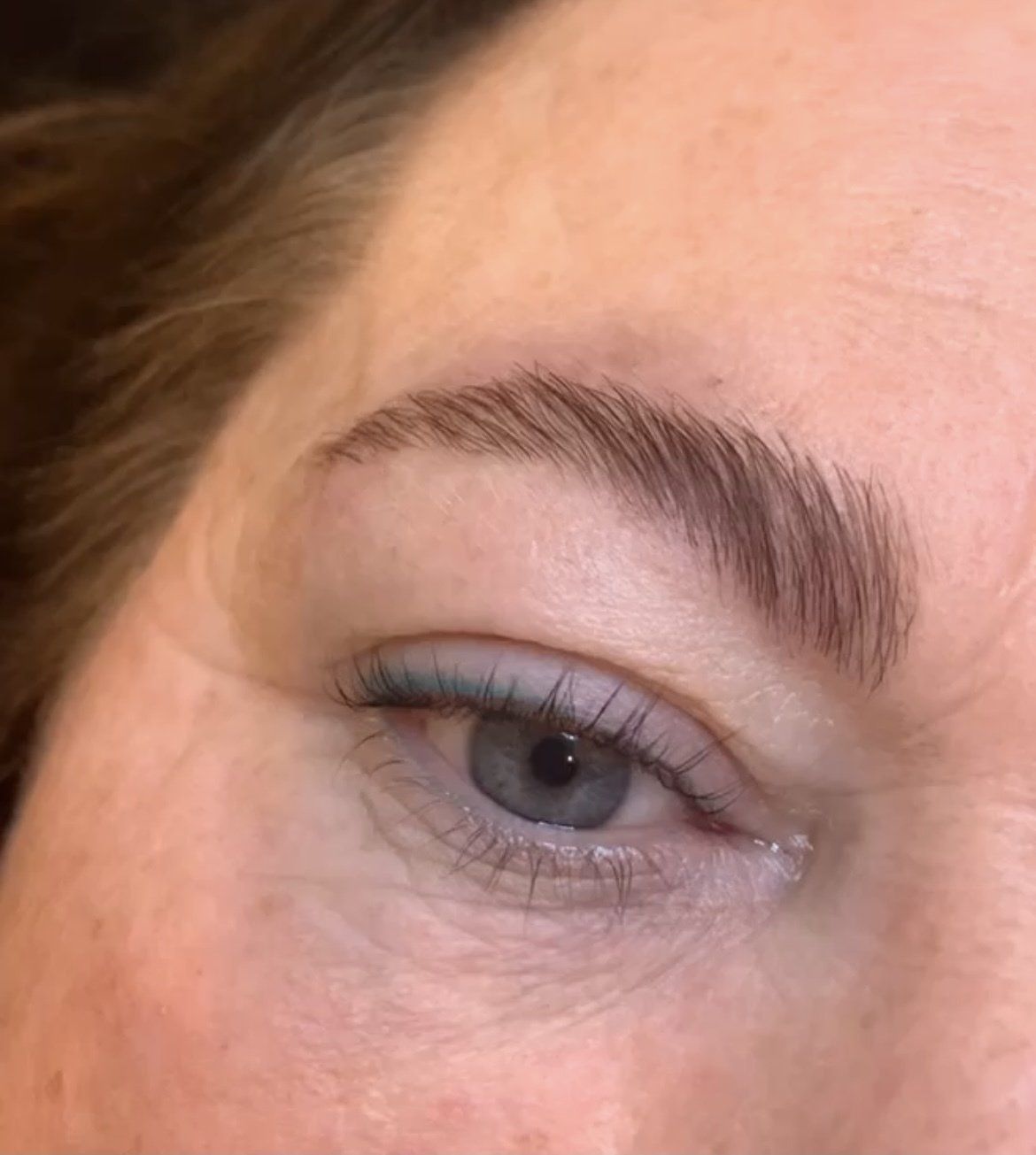 Browlift