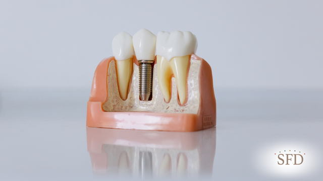 The Guide to Long-Term Success: Proper Dental Implant Maintenance