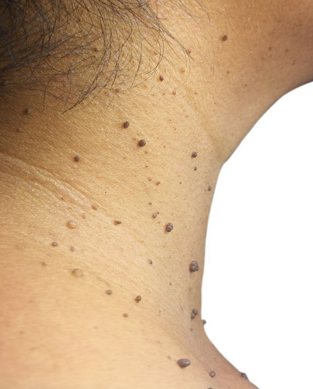 Skin Tag on Mature Skin — Advanced Cosmetic & Beauty Clinic in Bundaberg South, QLD