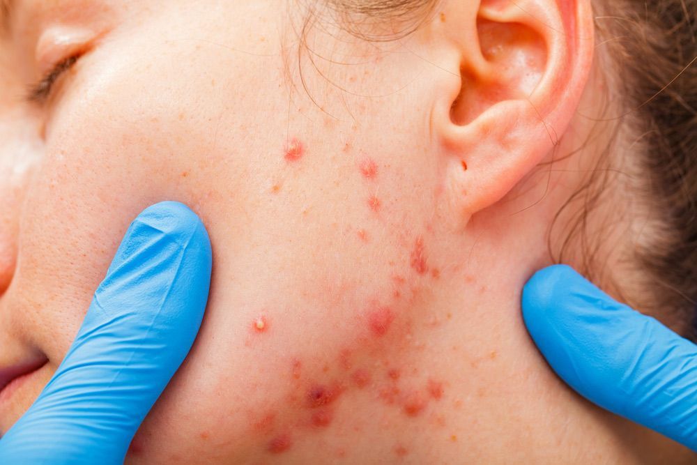 A Woman With Acne On Her Face Is Being Examined By A Doctor — Advanced Cosmetic & Beauty Clinic in Bundaberg South, QLD