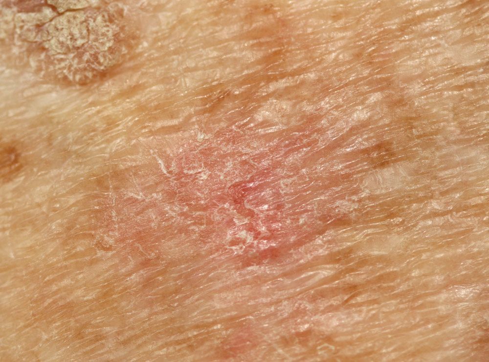 A Close Up Of A Person 's Skin With A Red Spot On It — Advanced Cosmetic & Beauty Clinic in Bundaberg South, QLD