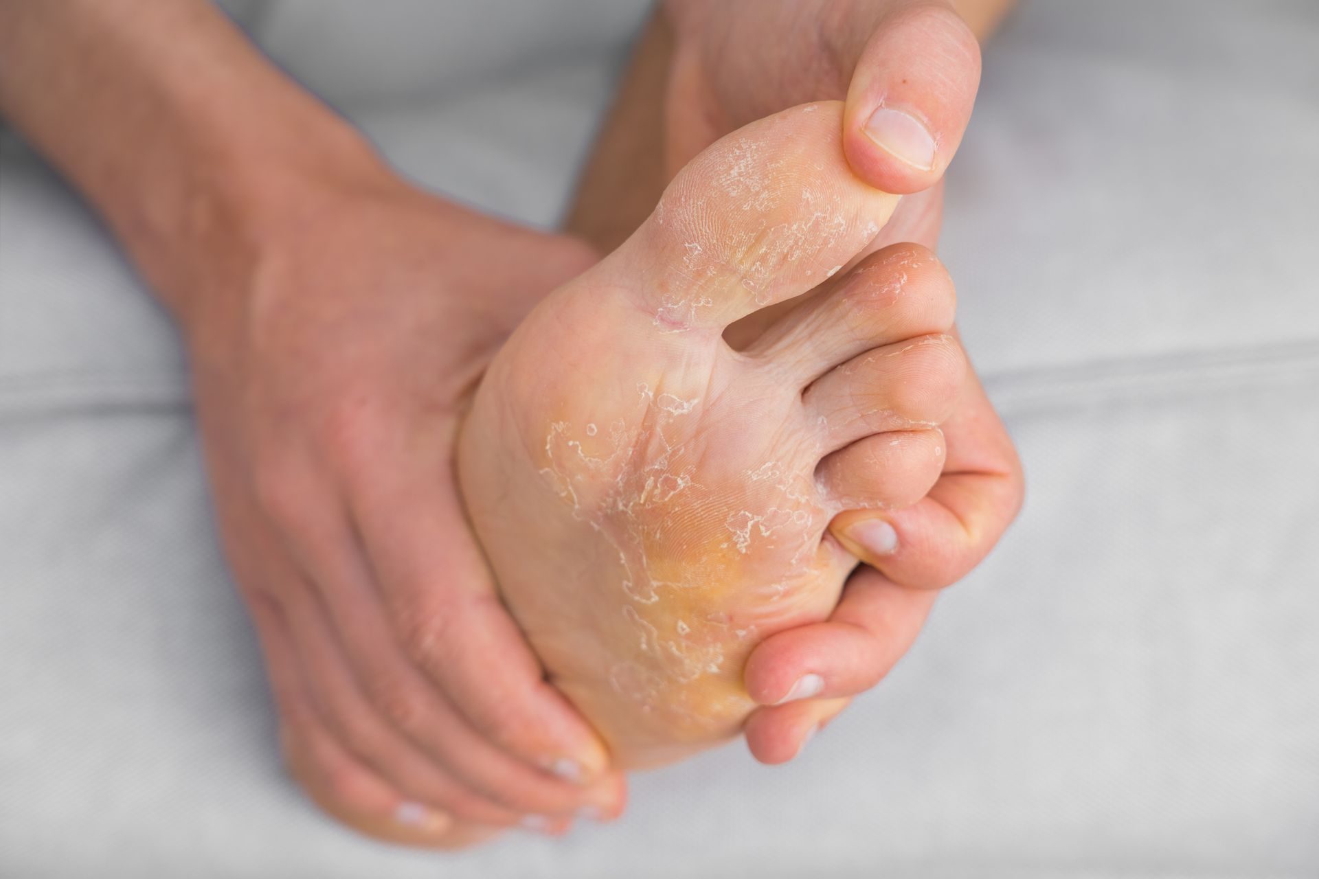 Foot with dry, peeling skin, held by hands, showing the sole and toes.