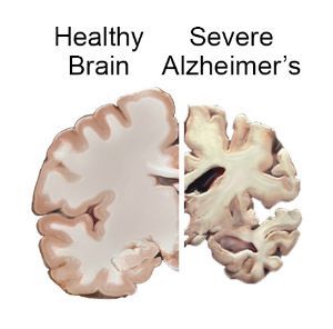 Comparison of a healthy brain (left) and a brain with severe Alzheimer's (right), showing significant tissue loss.