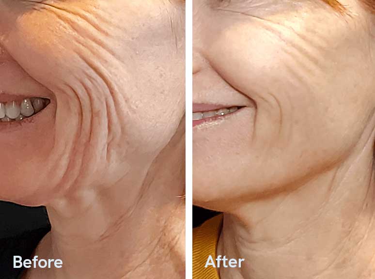 A before and after photo of a woman 's face with wrinkles.