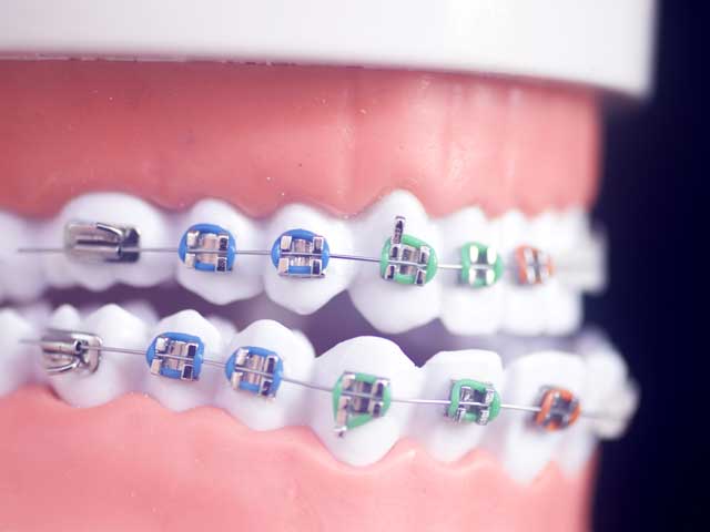 A close up of a model of teeth with braces on them.