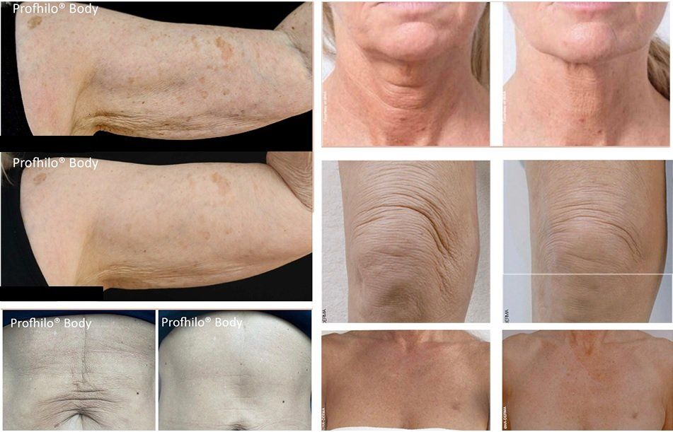 A before and after photo of a woman 's arm and neck