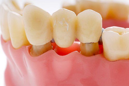 Dental Bridge | Dental Implants Endicott