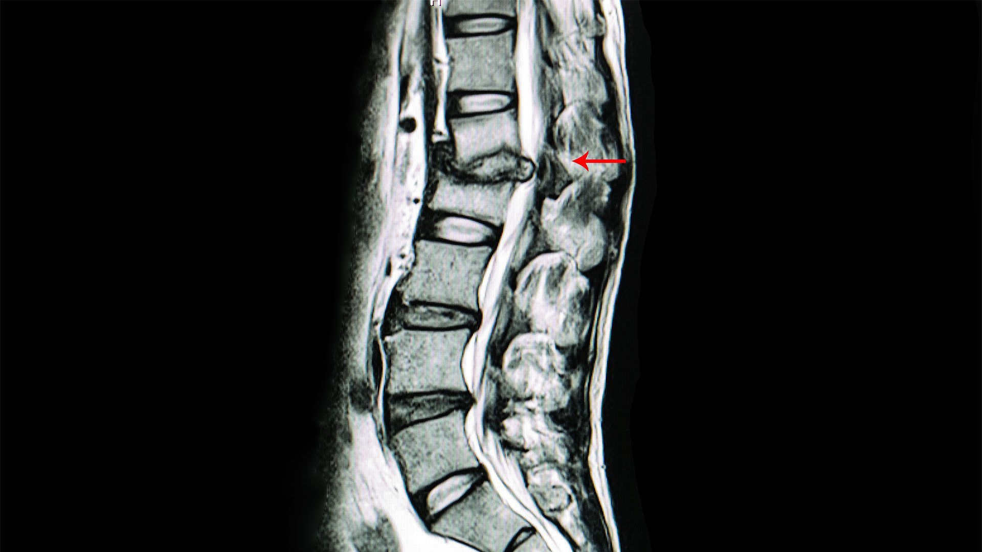 Spine MRI