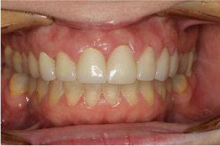 A close up of a person 's teeth with white teeth.