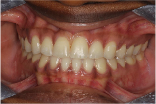 A close up of a person 's teeth with white teeth.