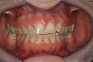 A close up of a person 's teeth with a broken tooth.